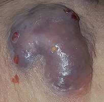 This lesion is about 4 inches across