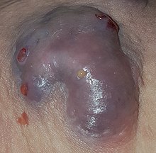 Hidradenitis Suppurativa. This lesion is about 4 inches across. HS Hidradenitis Suppurativa.jpg