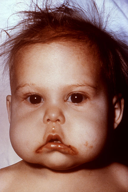 Child in the United States with signs of kwashiorkor, a dietary protein deficiency.