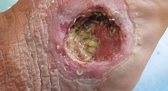 Maggot therapy on a wound on a diabetic foot.