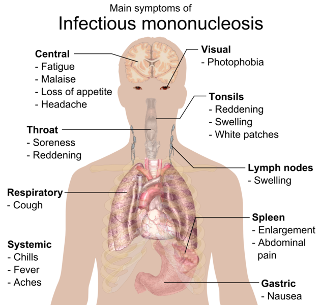 File:Main symptoms of Infectious mononucleosis.png