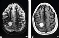 Angiosarcoma