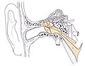 Vignette pour Syndrome tonique du muscle tenseur du tympan