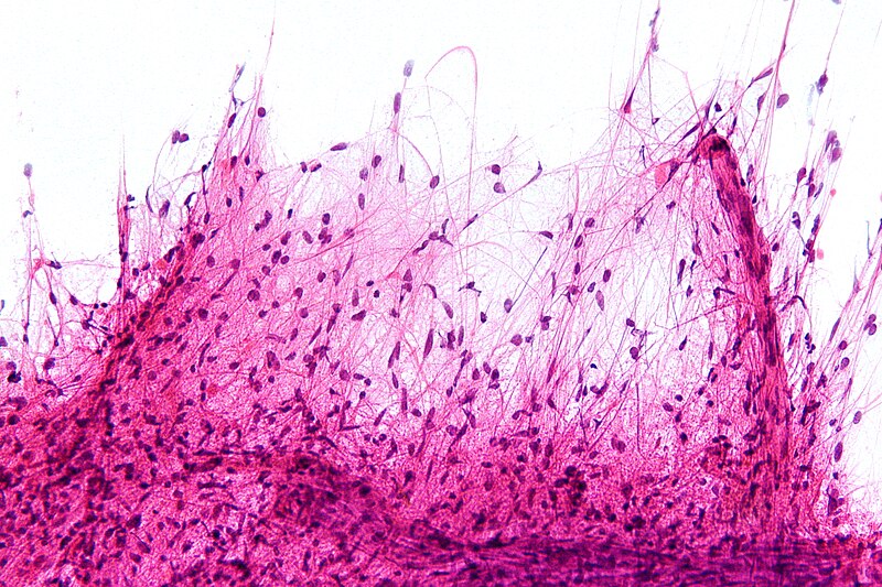 File:Pilocytic astrocytoma - smear - high mag.jpg