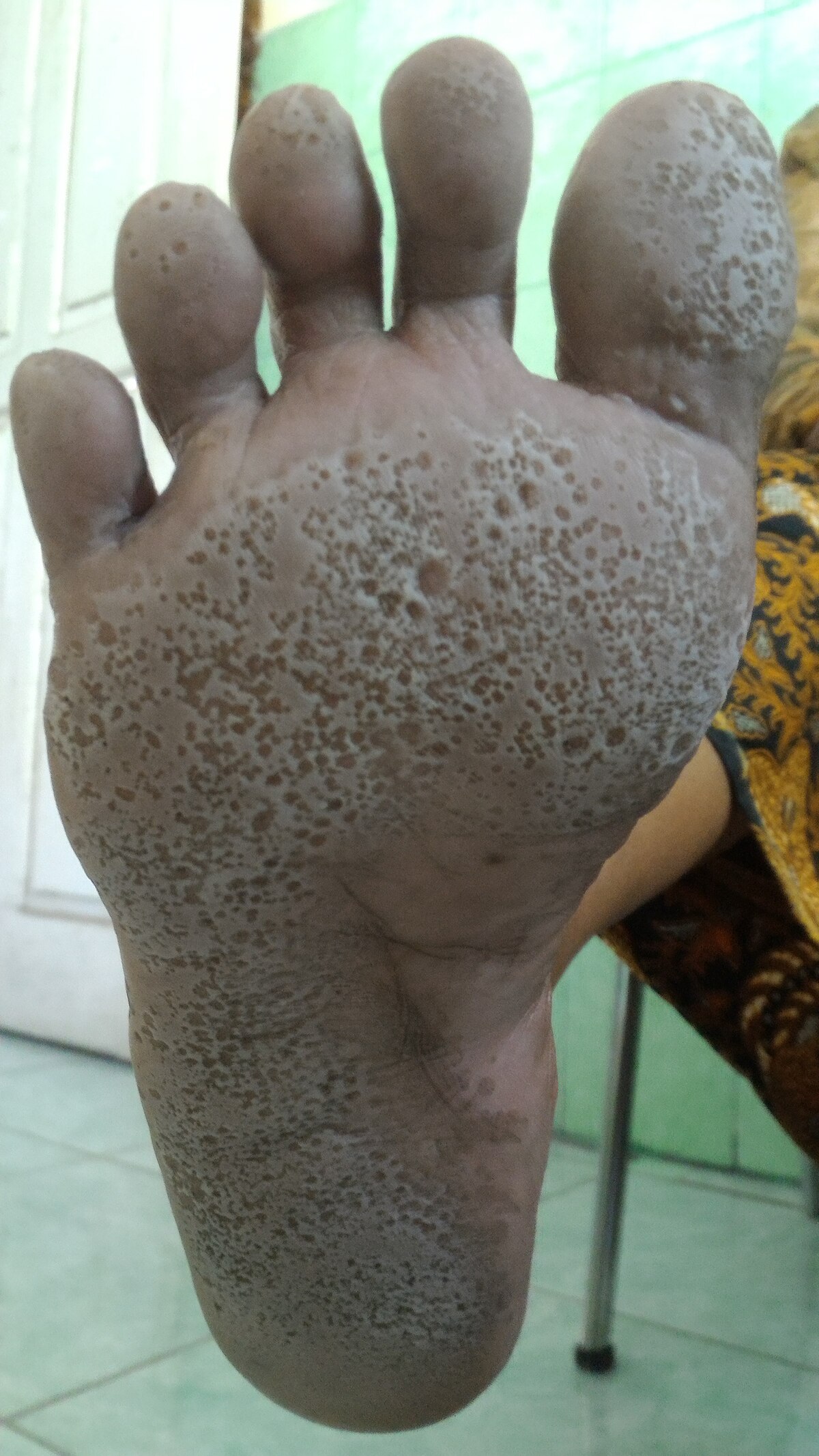 Why You Should Be Checking Your Soles and Palms If You Have a Dark  Complexion