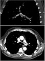 Angiografia per tomografia computada pulmonar que mostra una embòlia en les branques lobars d'ambdues artèries pulmonars principals.