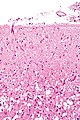 Reactive astrocytes - lfb - high mag.jpg