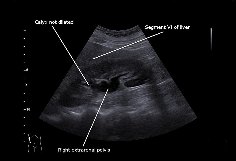 File:Right extrarenal pelvis as shown in sagittal view on ultrasound.jpg