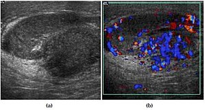 Scrotal Ultrasound