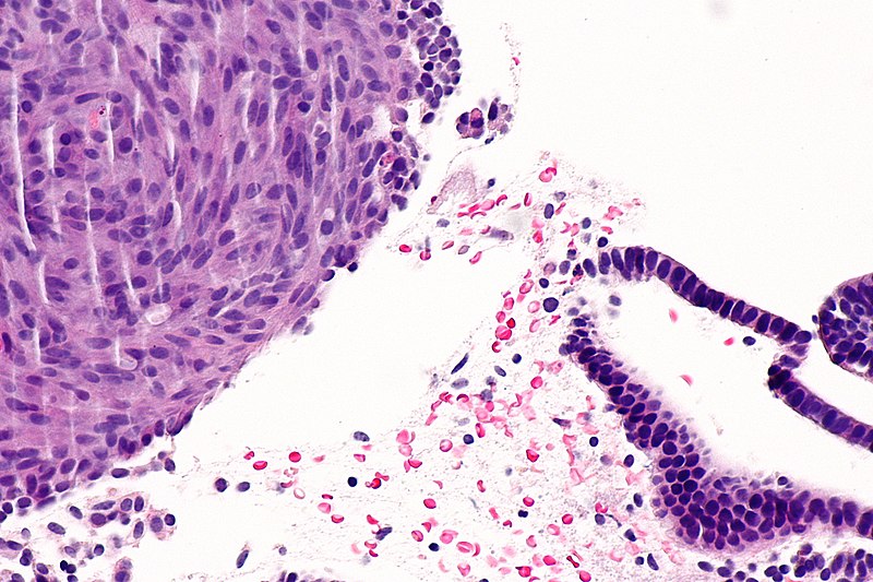 File:Squamous morule a - endometrium -- high mag.jpg