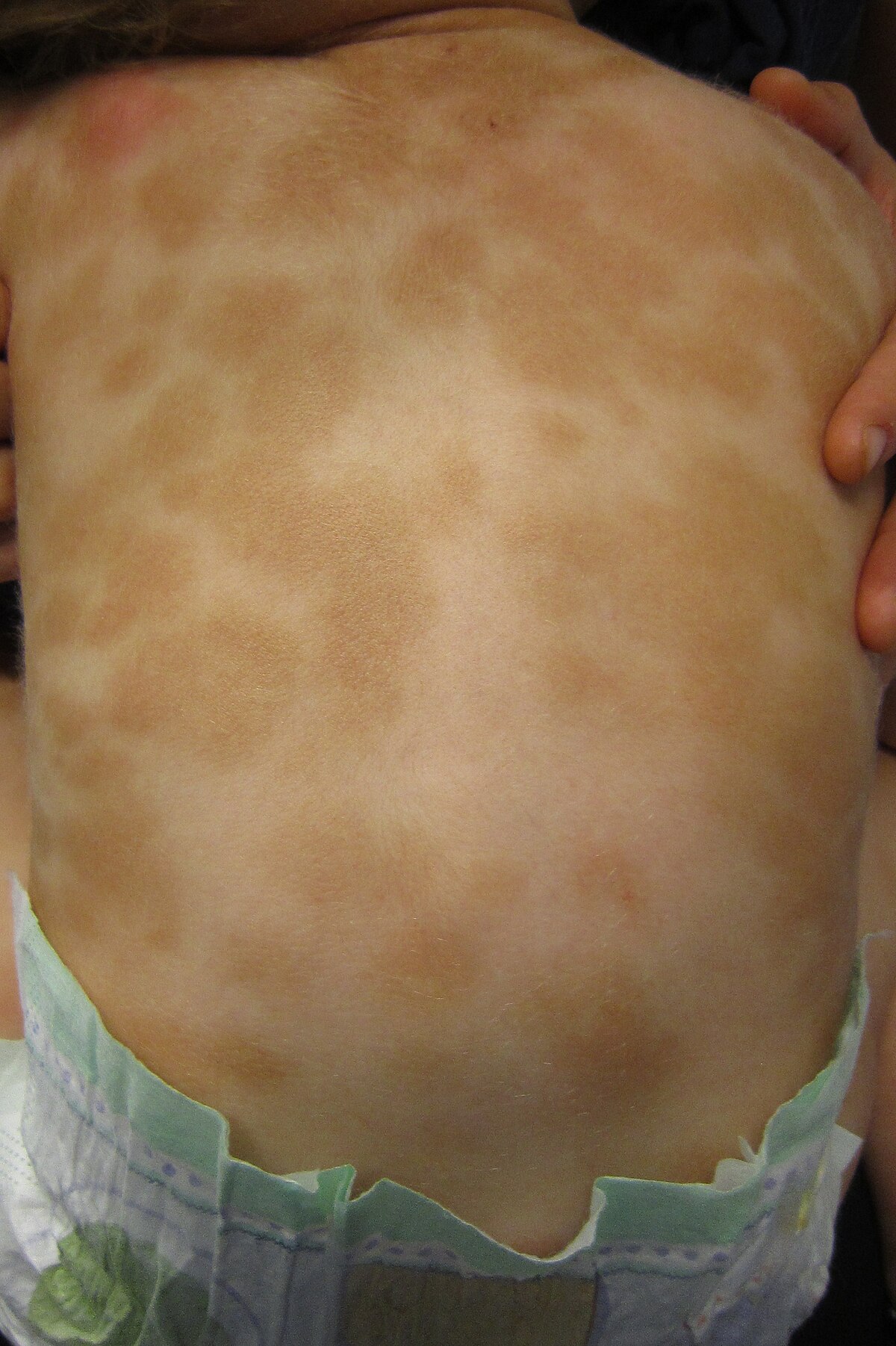 Dark spots on child's back