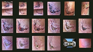 Wound healing The series of events that restore integrity to a damaged tissue, following an injury.