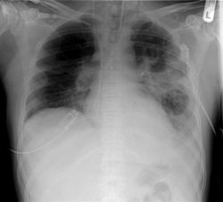 Férgek röntgenfelvételen a tüdőben