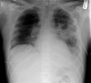 Una radiografia di polmoni umani