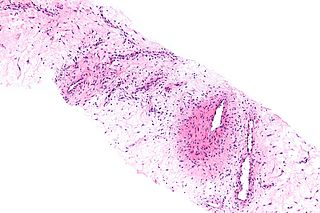 <span class="mw-page-title-main">Aggressive angiomyxoma</span> Medical condition