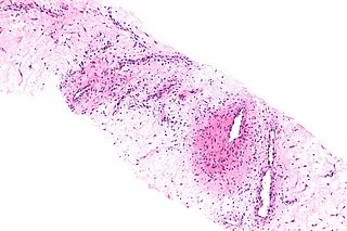 Aggressive angiomyxoma