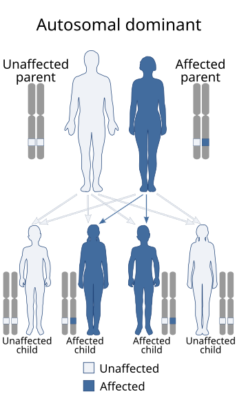 Sprengel's deformity is inherited in an autosomal dominant manner. Autosomal dominant - en.svg