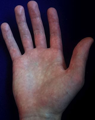 <span class="mw-page-title-main">Bier spots</span> Light spots on the hands, arms and legs