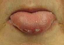 An individual who has bitten the tip of their tongue while having a seizure Bittentongue.JPG