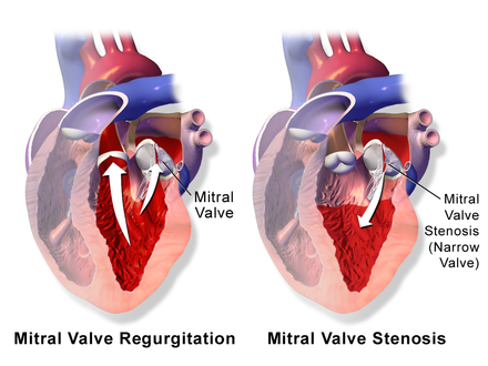mitral valve prolapse lifespan