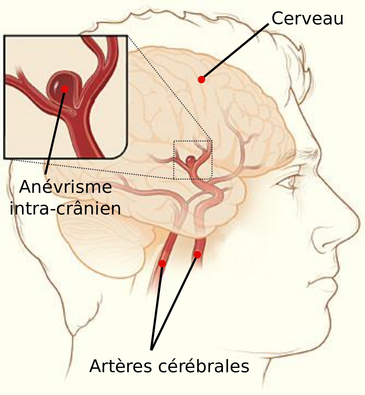 Як починається аневризма головного мозку?