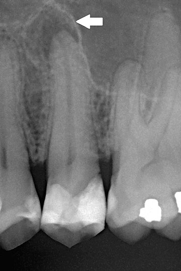 Periapical periodontitis