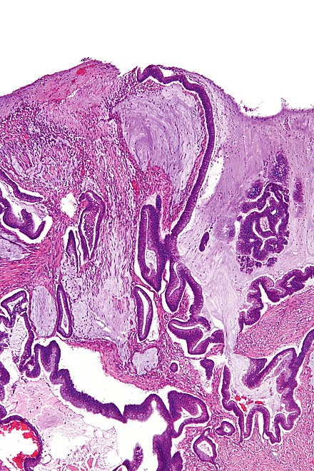 Micrograph of a mucinous adenocarcinoma of the colon. H&E stain.