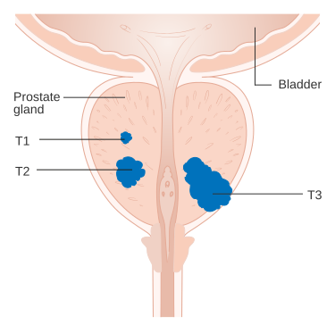 Diagram_showing_T1-3_stages_of_prostate_cancer_CRUK_278