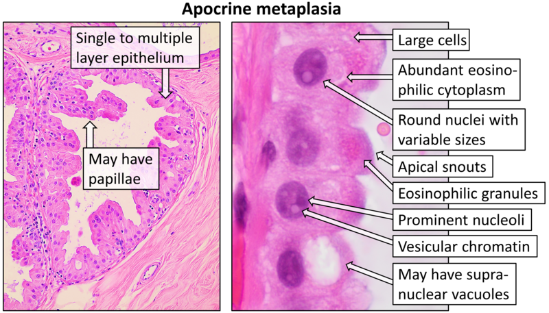 File:Histopathology of apocrine metaplasia of breast, annotated.png