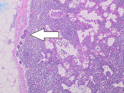 Histopathology of lymph node metastasis from a well differentiated neuroendocrine tumor of the midgut.jpg