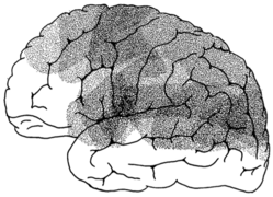 Isotope Localization of Infarcts in Aphasia.png