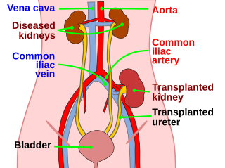 Kidney transplantation Medical procedure