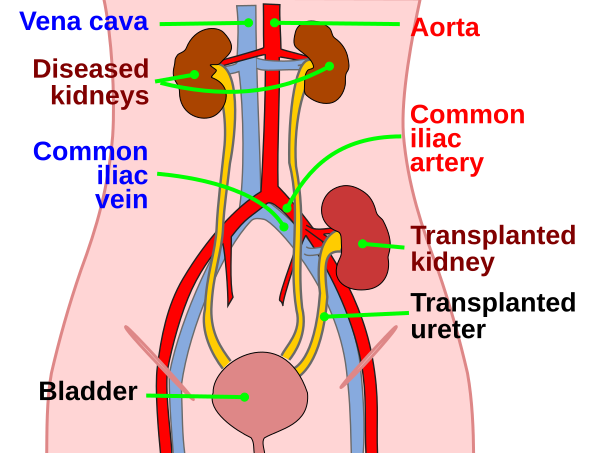 File:Kidtransplant.svg