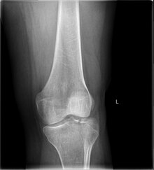 Lateral Tibial Plateau fracture XRay with Depression Lateral Tibial Plateau fracture XRay with Depression.jpg