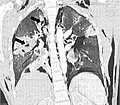 Miniatura para Laceración pulmonar