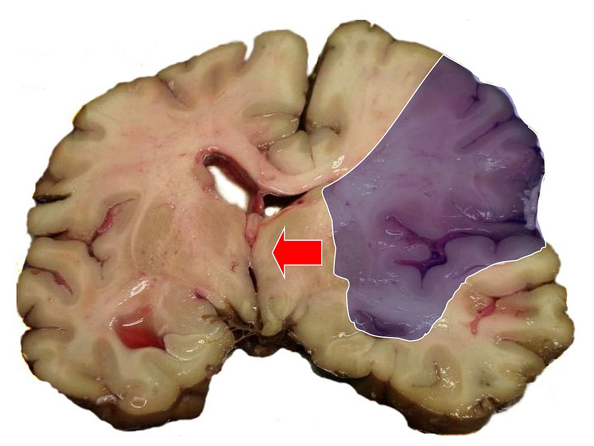 midline-shift-wikipedia