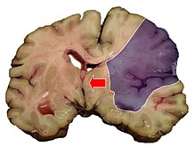 Midline shift (arrow) is present in this brain after a stroke (infarct depicted in shaded area). MCA-Stroke-Brain-Humn-2A.jpg
