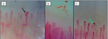 Capillaroscopic findings in patients with mild COVID-19
Enlarged loops (Black arrow)
Microhemorrhages (Red arrow)
Microthrombosis (Green arrow) MVD004.jpg