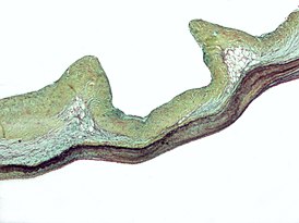 Myxomatous aortic valve.jpg