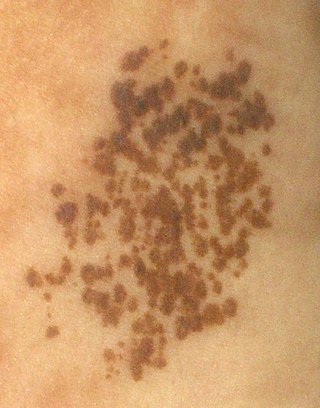 <span class="mw-page-title-main">Nevus spilus</span> Medical condition