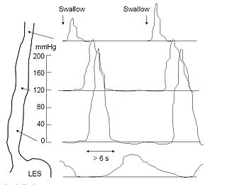 Esophageal motility study