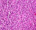 Plasmacytoma - another case.