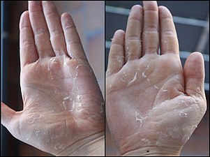 Peeling of hands