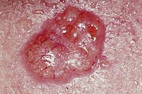 Basal cell carcinoma.jpg