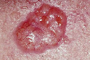 hpv related skin cancer)