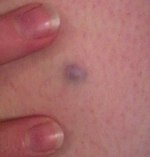 Blue Nevus (crop).jpg