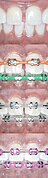 Braces Close Diastema Spaces.jpg