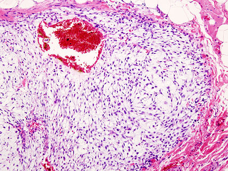 Sarcoma_sụn