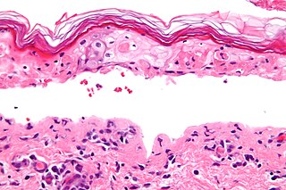 <span class="mw-page-title-main">Erythema multiforme major</span> Skin condition