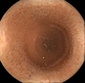 Image of the intestines acquired by capsule endoscopy Dunndarm.PNG